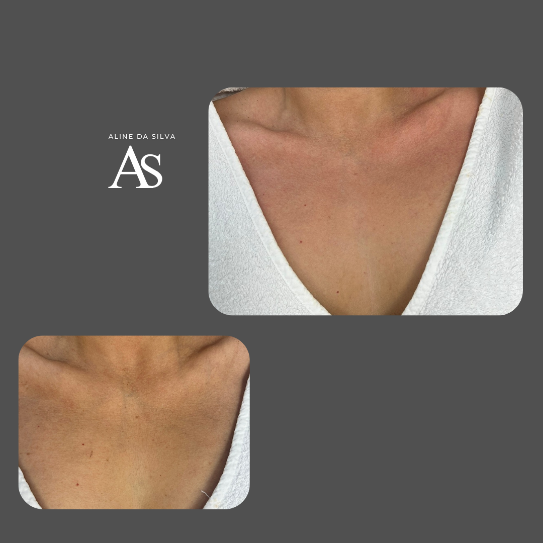 FIRMING LIPO AFTER CHILDBIRTH/WRINKLED BODY.