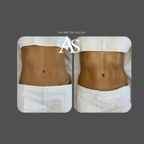 Lipo Effect Lymphatic Drainage