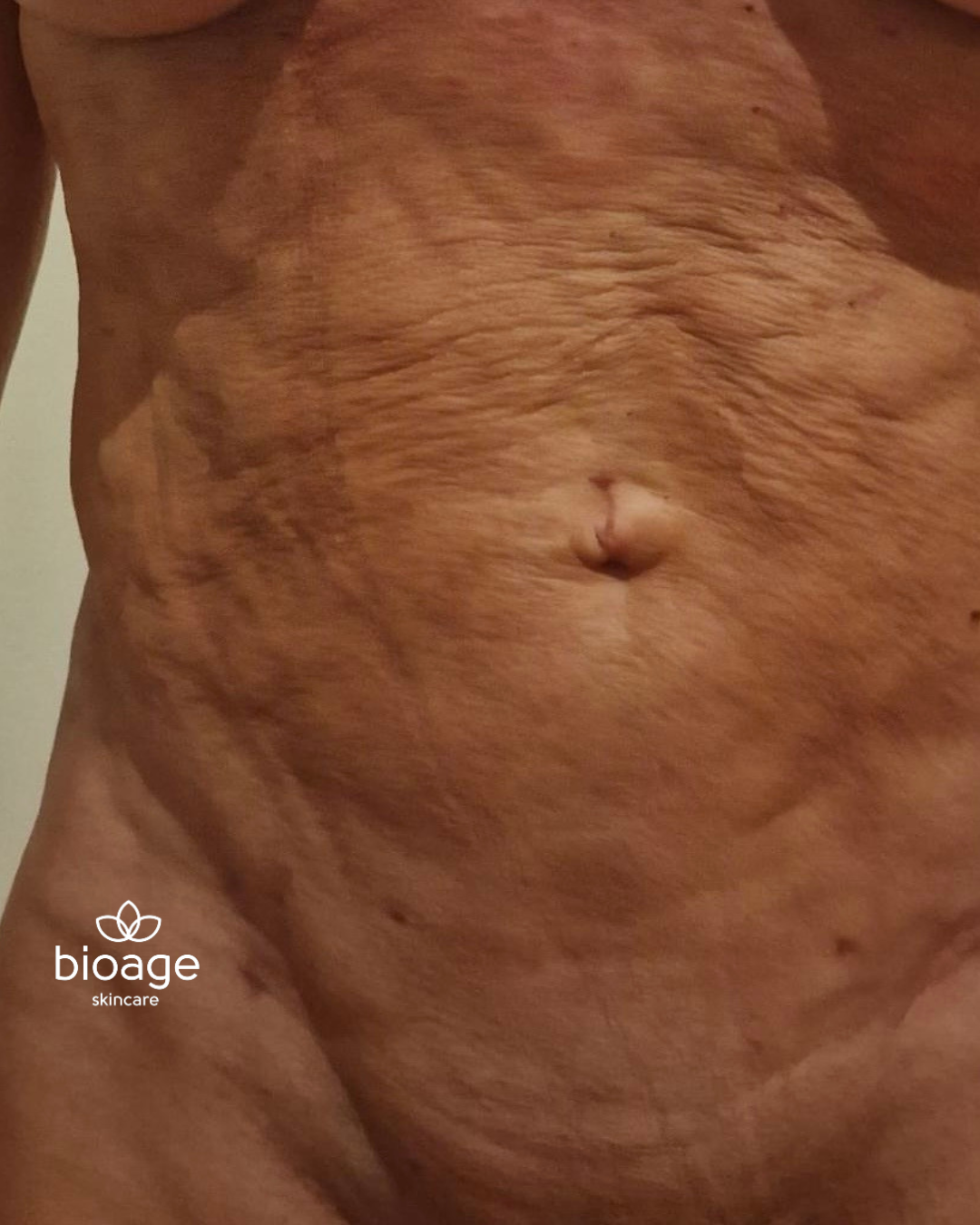 Post chirurgisch: FIBROSE CURSUS