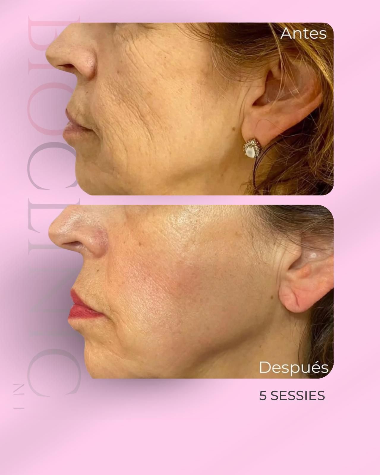 MASTERCLASS SEDUSKIN HYLA-PDRN & LIPAX LIPO ENZYMES