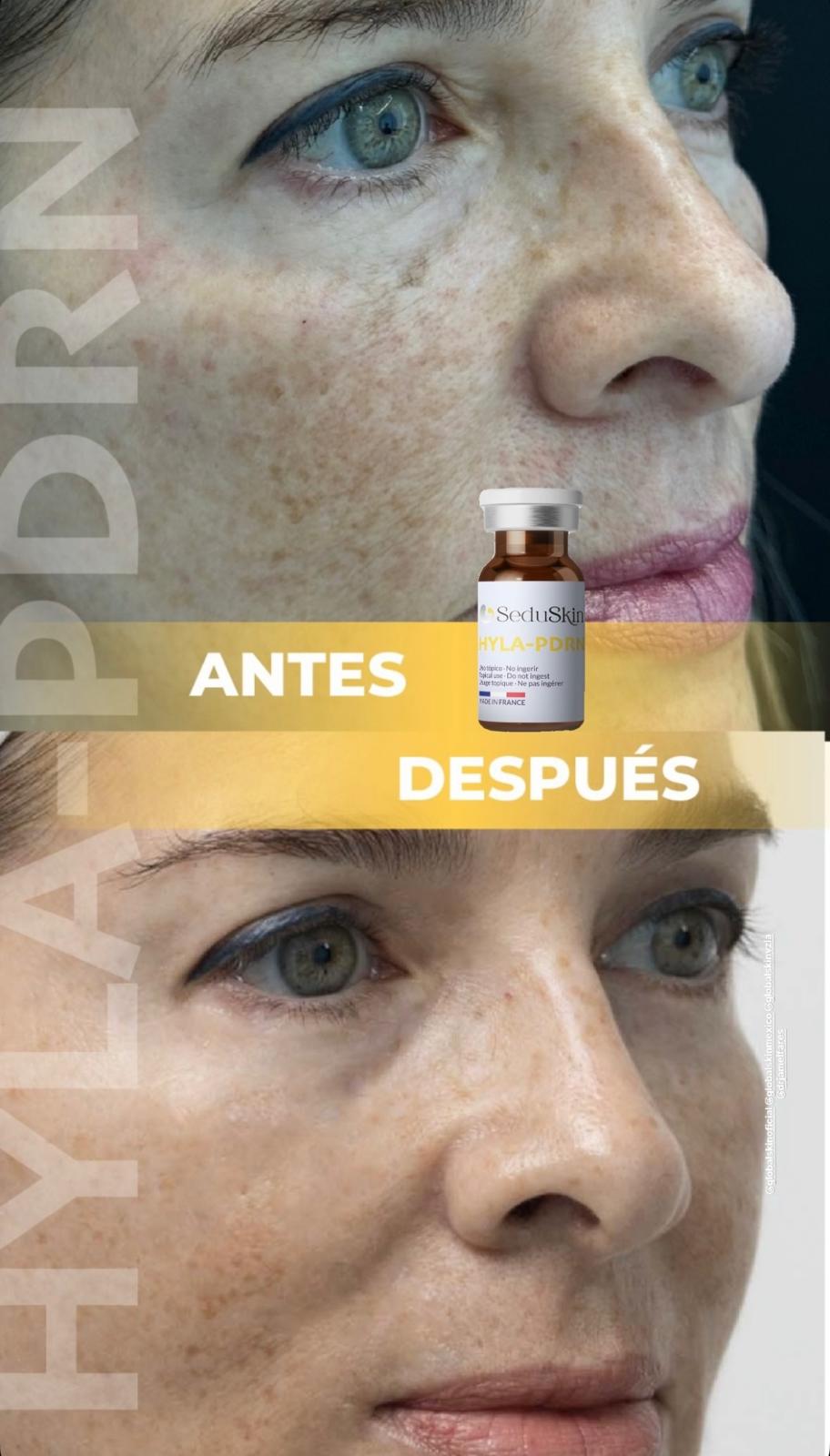 MASTERCLASS SEDUSKIN HYLA-PDRN & LIPAX LIPO ENZYMES