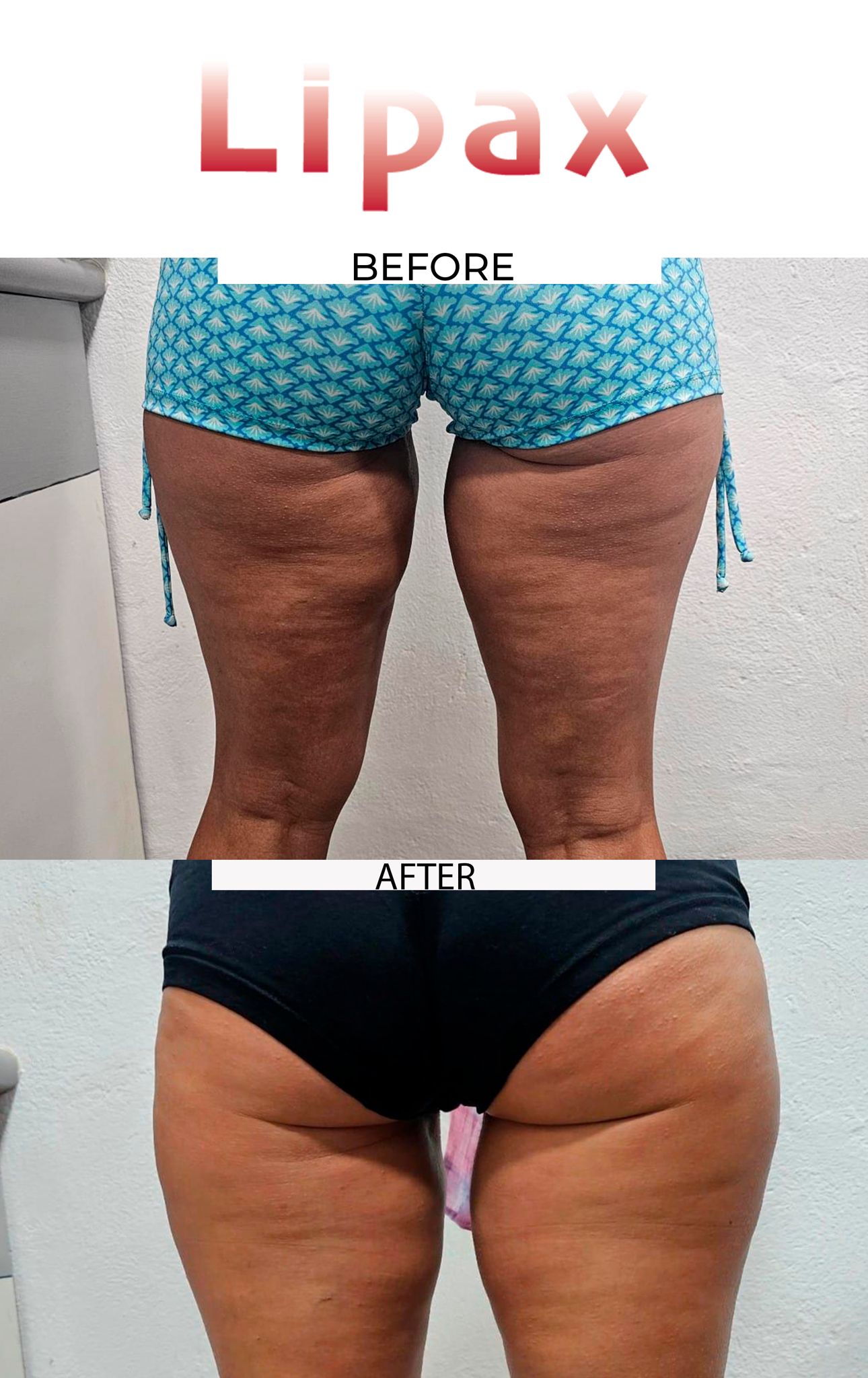 MESO GUN, HYALURON PEN EN LIPO ENZYMEN CURSUS FACE EN BODY