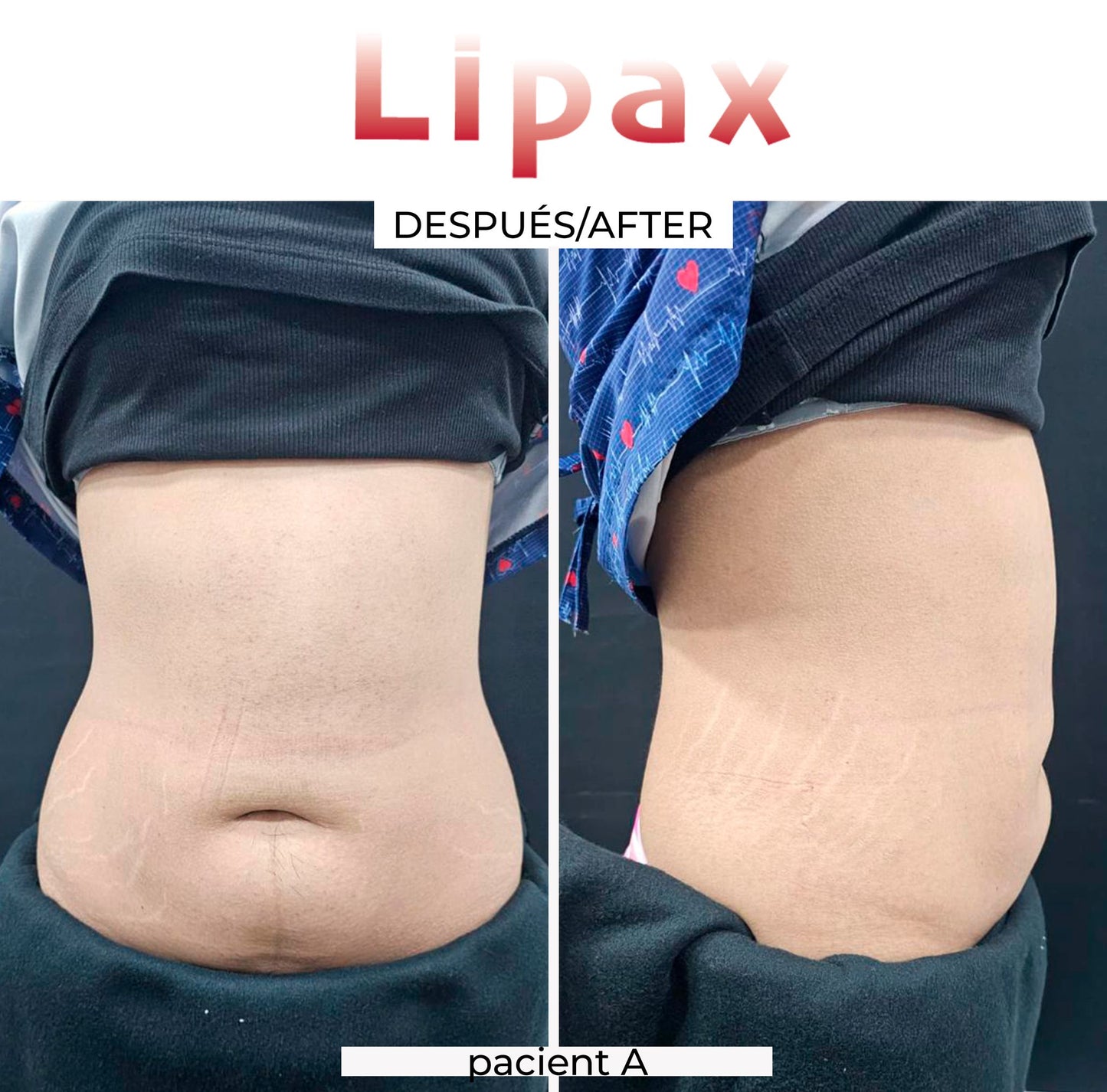 MESO GUN, HYALURON PEN EN LIPO ENZYMEN CURSUS FACE EN BODY